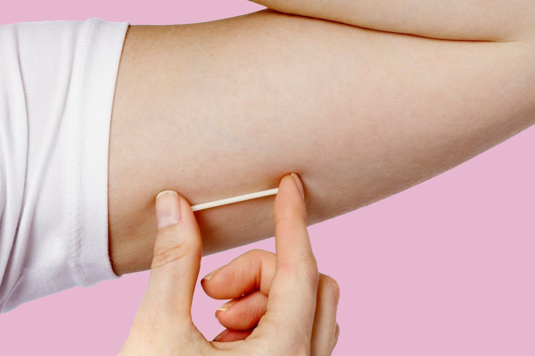 Подкожный имплант