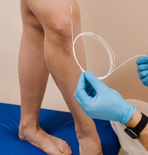 рекомендации после эвлк вен нижних конечностей